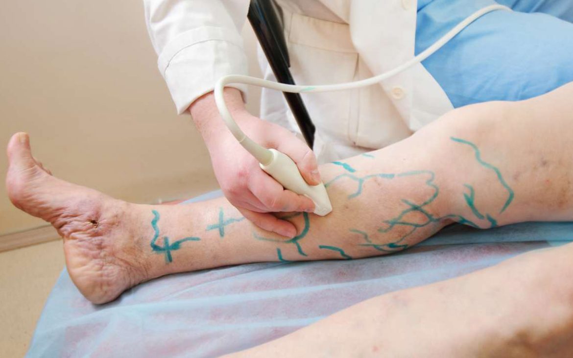 Non-Surgical Vein Treatments